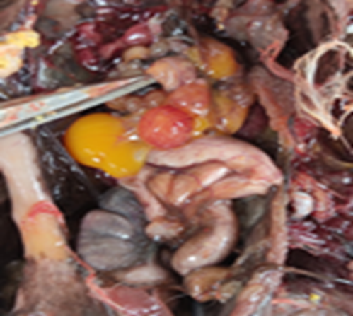 Trứng vỡ trong xoang bụng